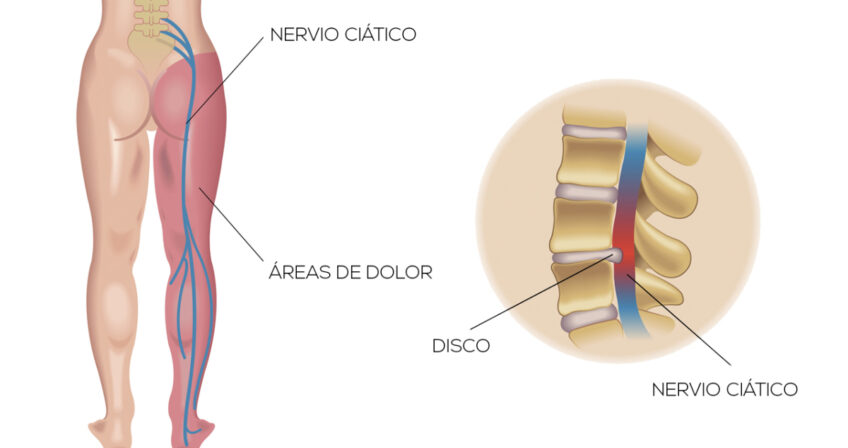 Diferencias entre ciática y pseudociática